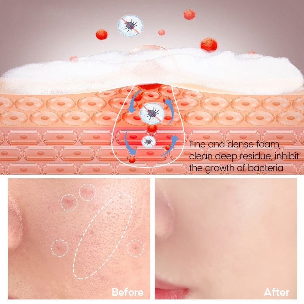 [VIBRANT GLAMOUR] Salicylic Acid Acne Soap Treatment Pore Exfoliating Foam Face Body