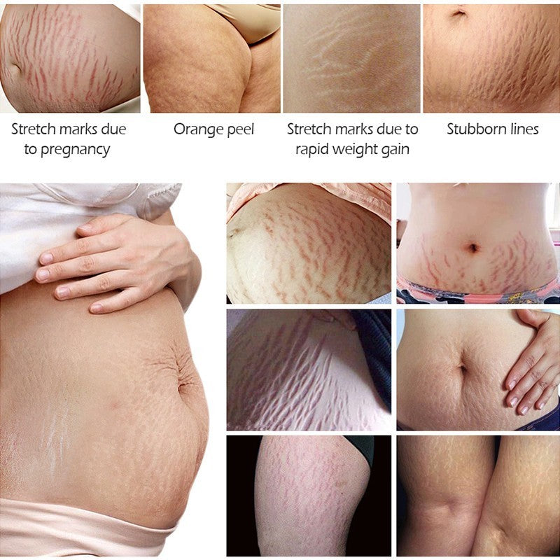[VIBRANT GLAMOUR] TREATMENT STRETCH MARK Remover Cream Maternity Repair pregnancy